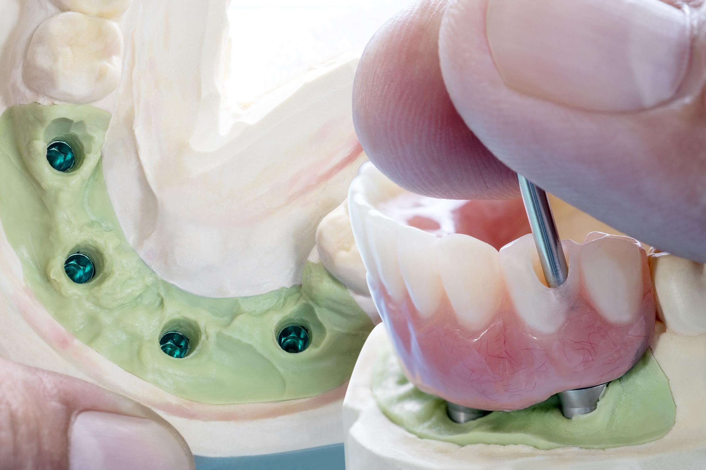 Maffei Medical | Dentista a Siena, protesi dentarie fisse, corone, capsule