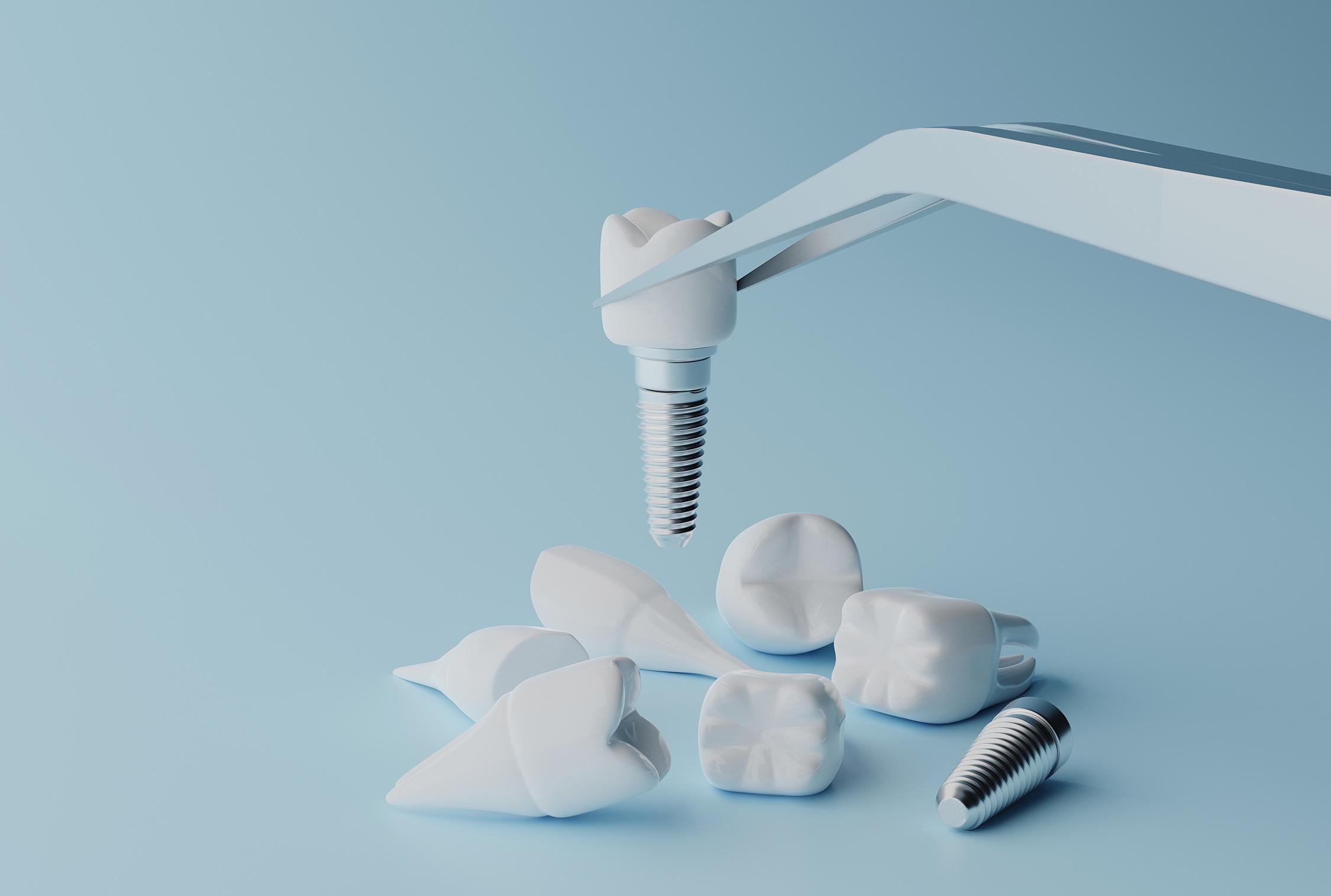 Maffei Medical | Dentista a Siena, interventi per la rigenerazione ossea